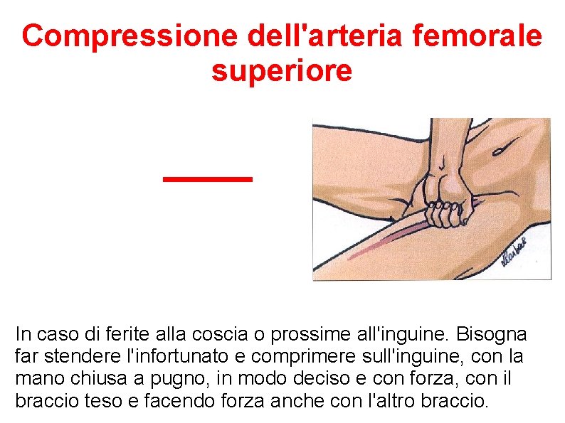 Compressione dell'arteria femorale superiore In caso di ferite alla coscia o prossime all'inguine. Bisogna