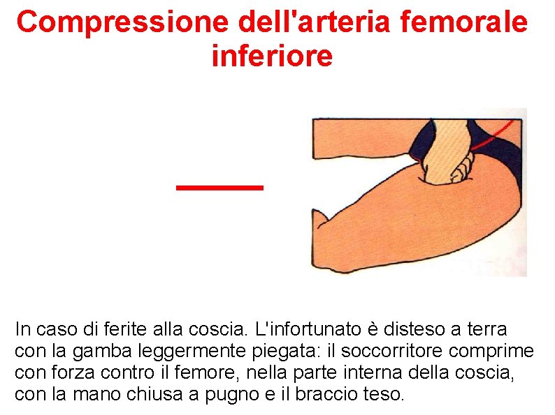 Compressione dell'arteria femorale inferiore In caso di ferite alla coscia. L'infortunato è disteso a