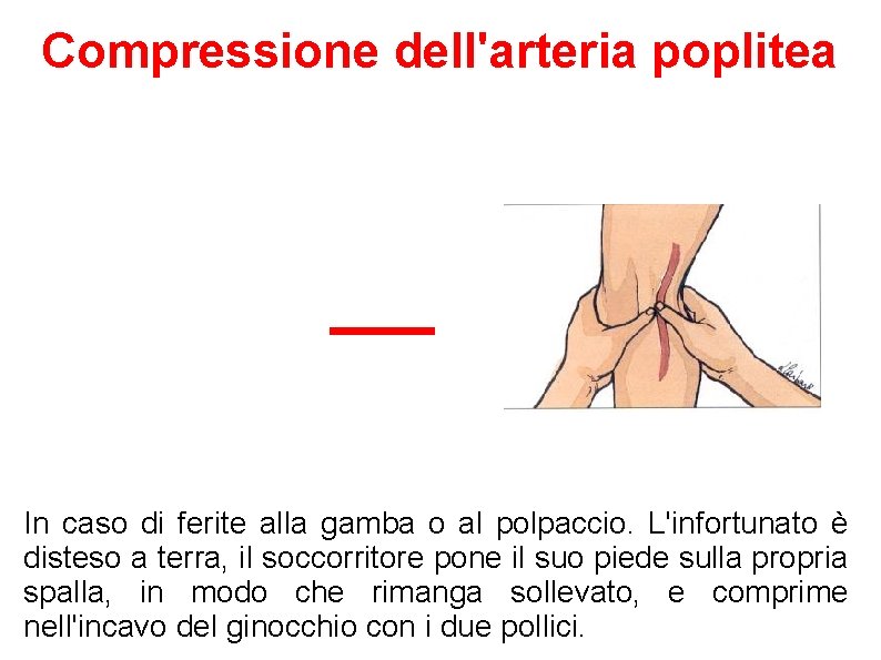 Compressione dell'arteria poplitea In caso di ferite alla gamba o al polpaccio. L'infortunato è