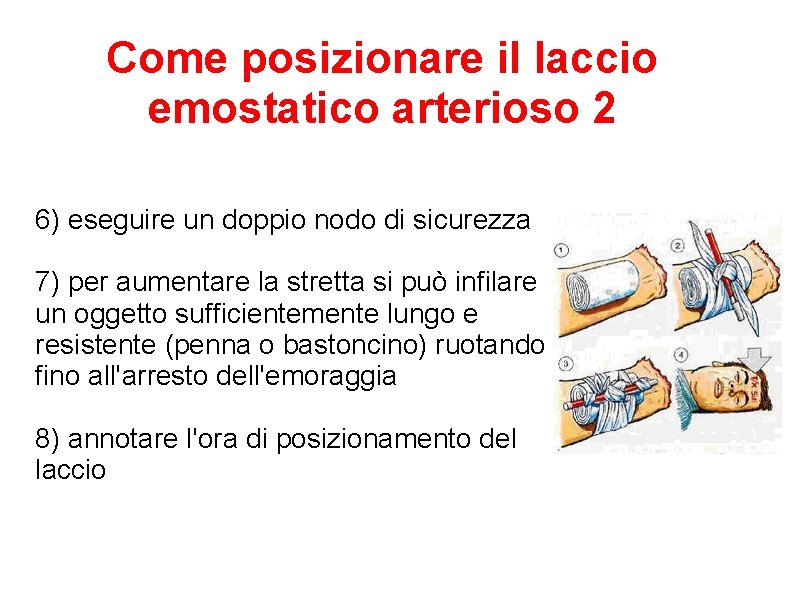 Come posizionare il laccio emostatico arterioso 2 6) eseguire un doppio nodo di sicurezza