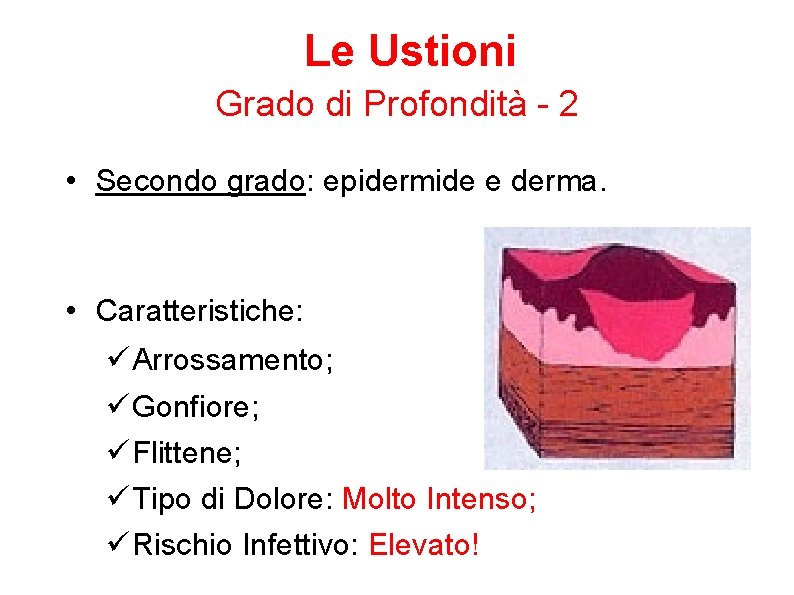 Le Ustioni Grado di Profondità - 2 • Secondo grado: epidermide e derma. •