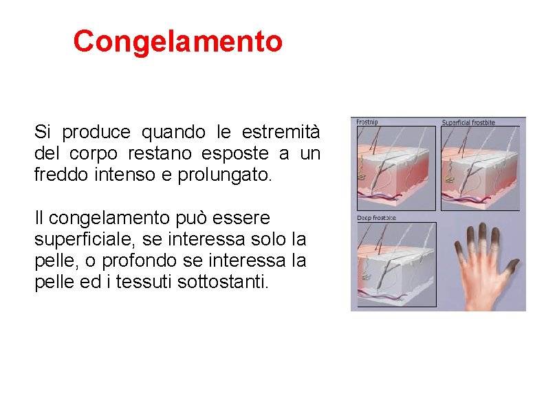 Congelamento Si produce quando le estremità del corpo restano esposte a un freddo intenso