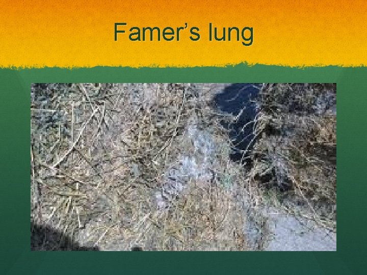 Famer’s lung 