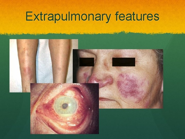 Extrapulmonary features 