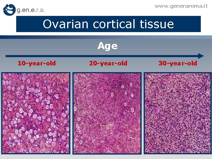 www. generaroma. it Ovarian cortical tissue Age 10 -year-old 20 -year-old 30 -year-old 