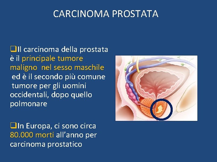 CARCINOMA PROSTATA q. Il carcinoma della prostata è il principale tumore maligno nel sesso