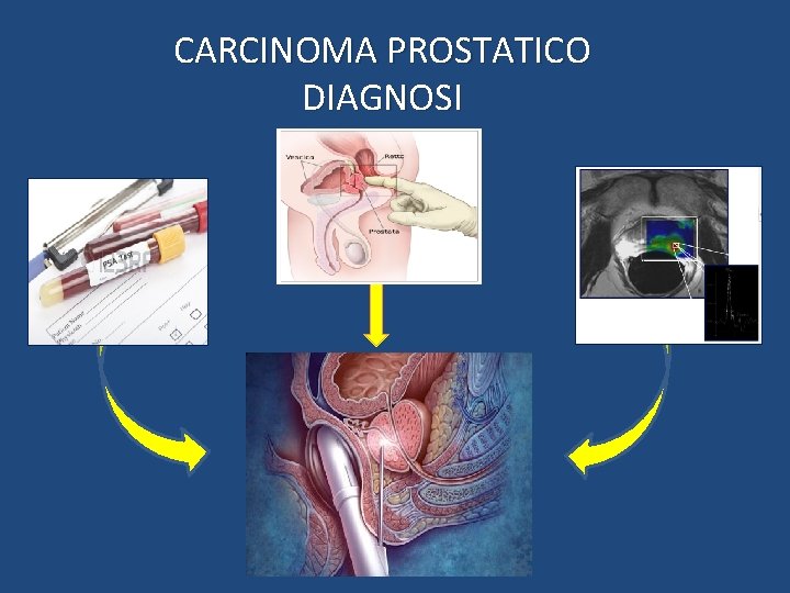 CARCINOMA PROSTATICO DIAGNOSI 