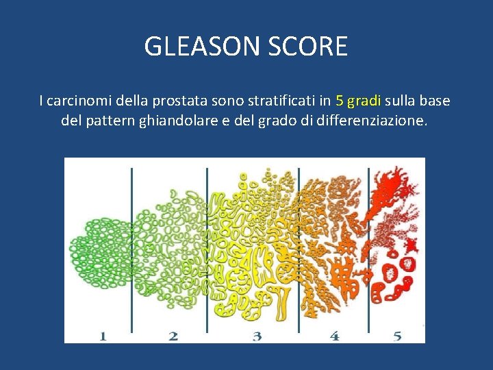 GLEASON SCORE I carcinomi della prostata sono stratificati in 5 gradi sulla base del