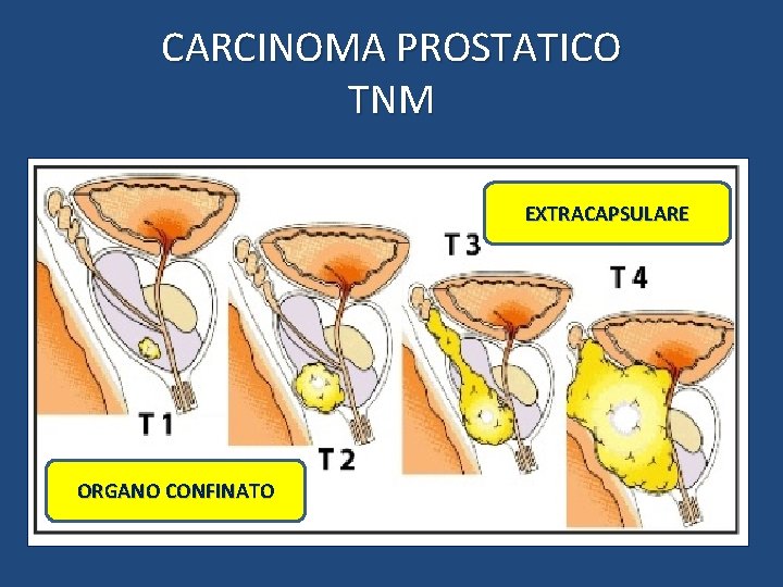 CARCINOMA PROSTATICO TNM EXTRACAPSULARE ORGANO CONFINATO 