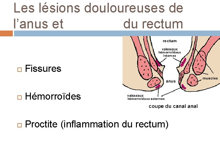 Les lésions douloureuses de l’anus et du rectum Fissures Hémorroïdes Proctite (inflammation du rectum)