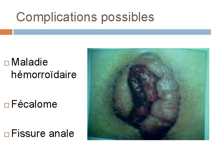 Complications possibles Maladie hémorroïdaire Fécalome Fissure anale 