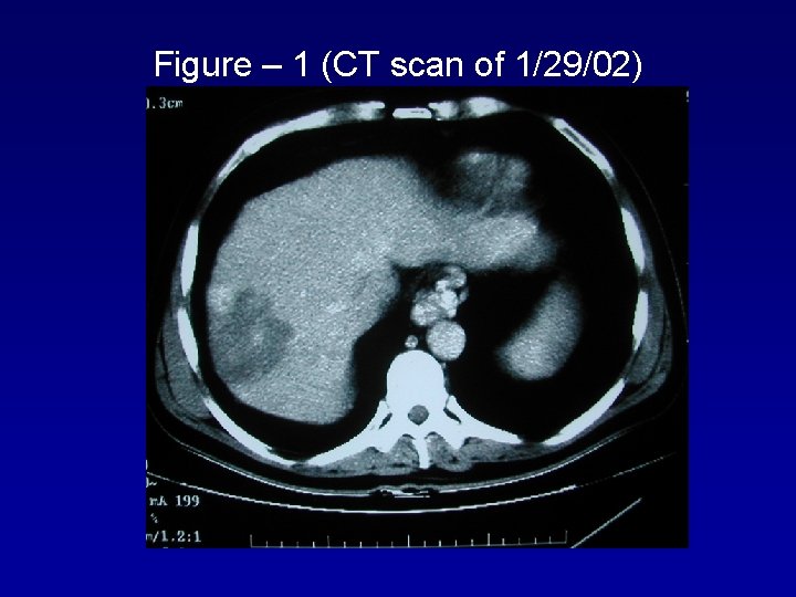 Figure – 1 (CT scan of 1/29/02) 