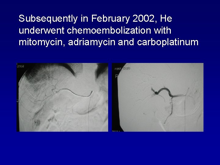 Subsequently in February 2002, He underwent chemoembolization with mitomycin, adriamycin and carboplatinum 