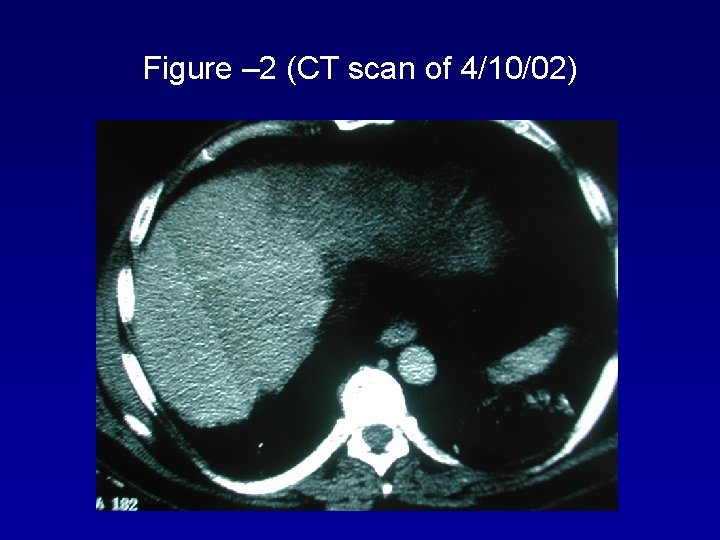 Figure – 2 (CT scan of 4/10/02) 