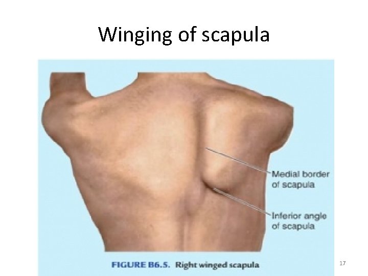 Winging of scapula 17 