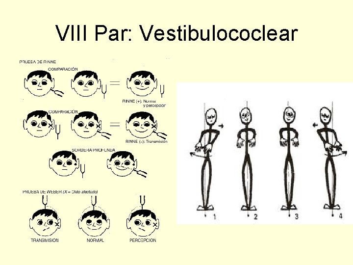 VIII Par: Vestibulococlear 