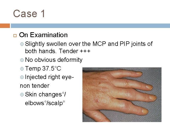 Case 1 On Examination Slightly swollen over the MCP and PIP joints of both