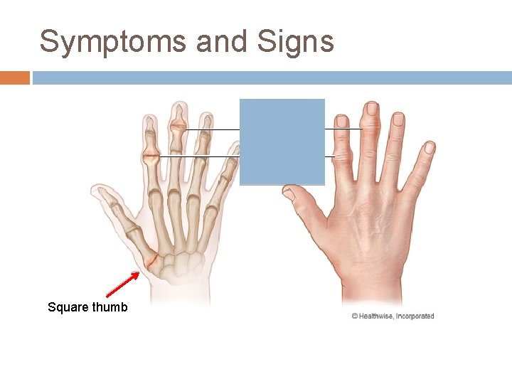Symptoms and Signs Square thumb 