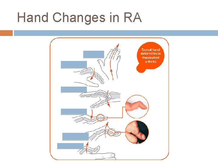 Hand Changes in RA 