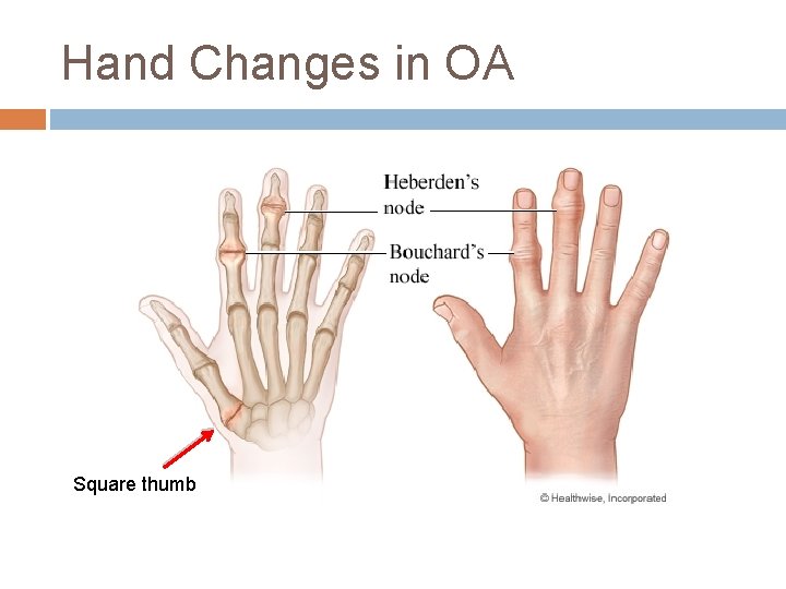 Hand Changes in OA Square thumb 