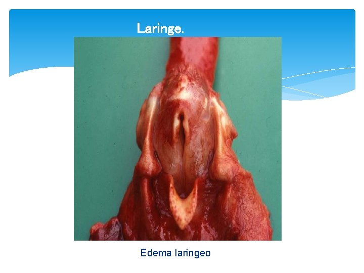 Laringe. Edema laringeo 
