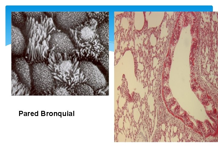 Pared Bronquial 