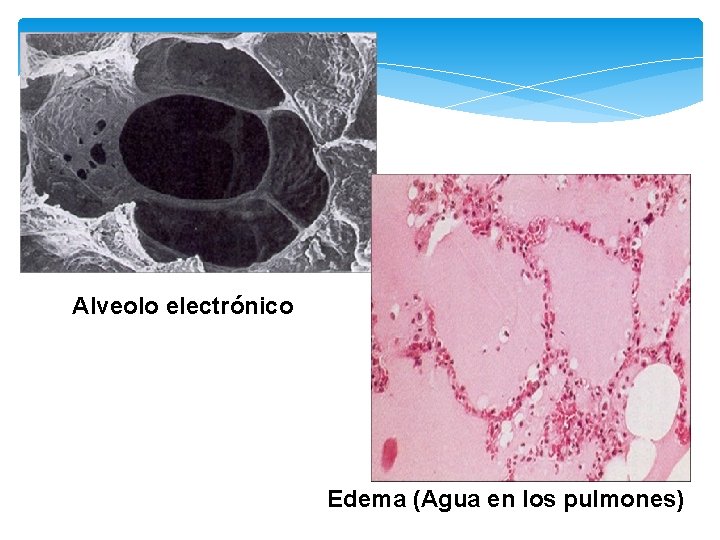 Alveolo electrónico Edema (Agua en los pulmones) 