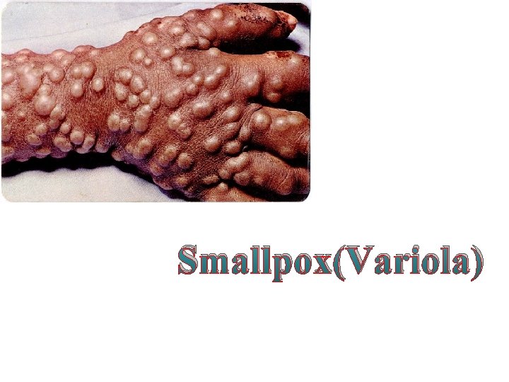 Smallpox(Variola) 