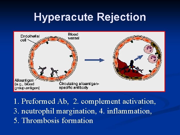 Hyperacute Rejection 1. Preformed Ab, 2. complement activation, 3. neutrophil margination, 4. inflammation, 5.