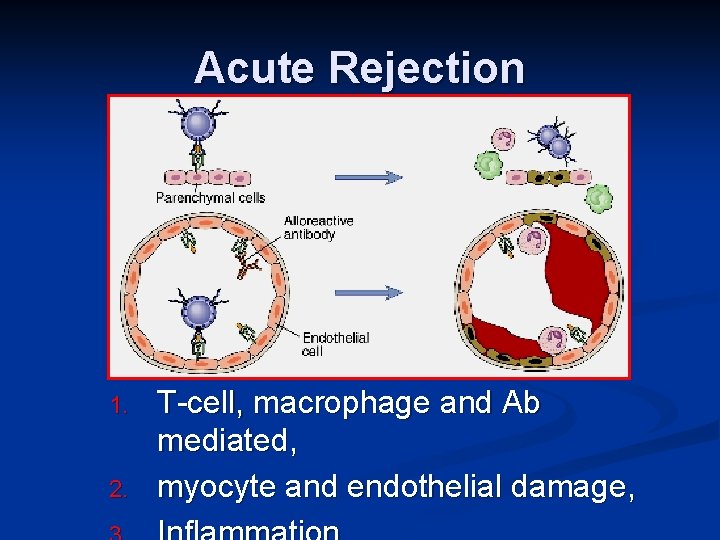 Acute Rejection 1. 2. T-cell, macrophage and Ab mediated, myocyte and endothelial damage, 