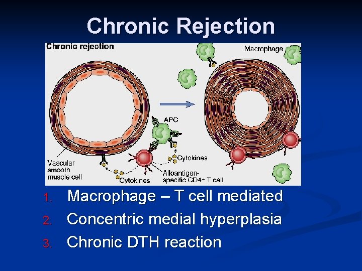 Chronic Rejection 1. 2. 3. Macrophage – T cell mediated Concentric medial hyperplasia Chronic