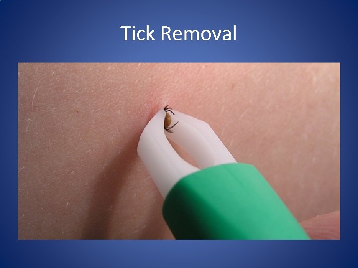 Tick Removal 