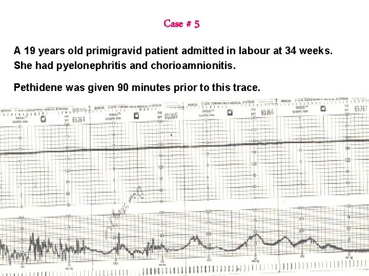Case # 5 A 19 years old primigravid patient admitted in labour at 34 Case # 5 A 19 years old primigravid patient admitted in labour at 34