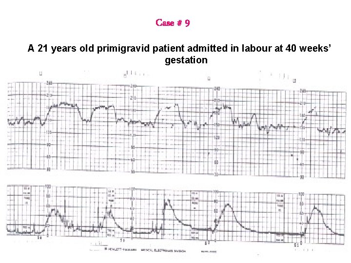 Case # 9 A 21 years old primigravid patient admitted in labour at 40 Case # 9 A 21 years old primigravid patient admitted in labour at 40