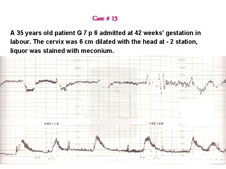 Case # 13 A 35 years old patient G 7 p 6 admitted at Case # 13 A 35 years old patient G 7 p 6 admitted at