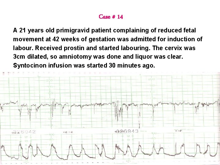 Case # 14 A 21 years old primigravid patient complaining of reduced fetal movement Case # 14 A 21 years old primigravid patient complaining of reduced fetal movement
