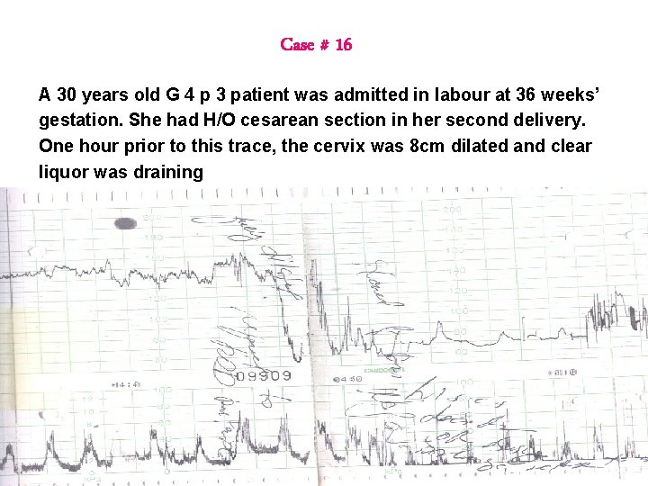 Case # 16 A 30 years old G 4 p 3 patient was admitted Case # 16 A 30 years old G 4 p 3 patient was admitted