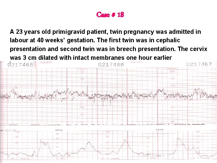 Case # 18 A 23 years old primigravid patient, twin pregnancy was admitted in Case # 18 A 23 years old primigravid patient, twin pregnancy was admitted in