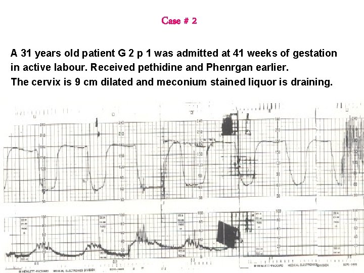 Case # 2 A 31 years old patient G 2 p 1 was admitted Case # 2 A 31 years old patient G 2 p 1 was admitted