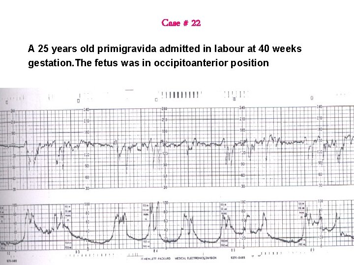Case # 22 A 25 years old primigravida admitted in labour at 40 weeks Case # 22 A 25 years old primigravida admitted in labour at 40 weeks