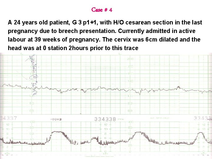 Case # 4 A 24 years old patient, G 3 p 1+1, with H/O Case # 4 A 24 years old patient, G 3 p 1+1, with H/O