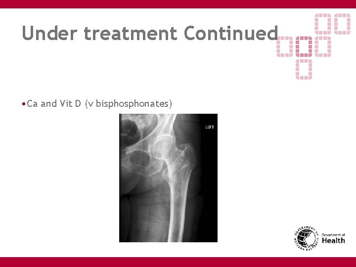 Under treatment Continued • Ca and Vit D (v bisphonates) 