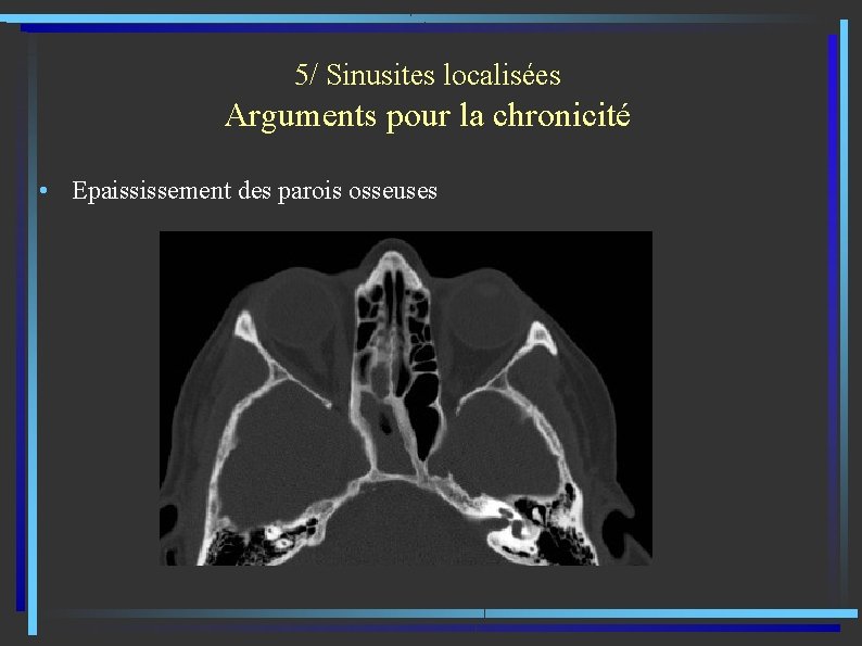5/ Sinusites localisées Arguments pour la chronicité • Epaississement des parois osseuses 
