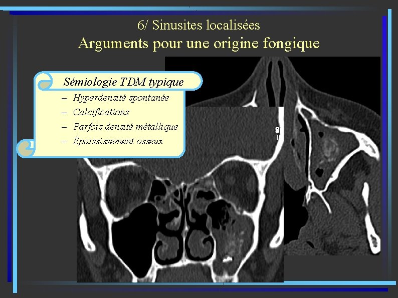 6/ Sinusites localisées Arguments pour une origine fongique Sémiologie TDM typique – – Hyperdensité