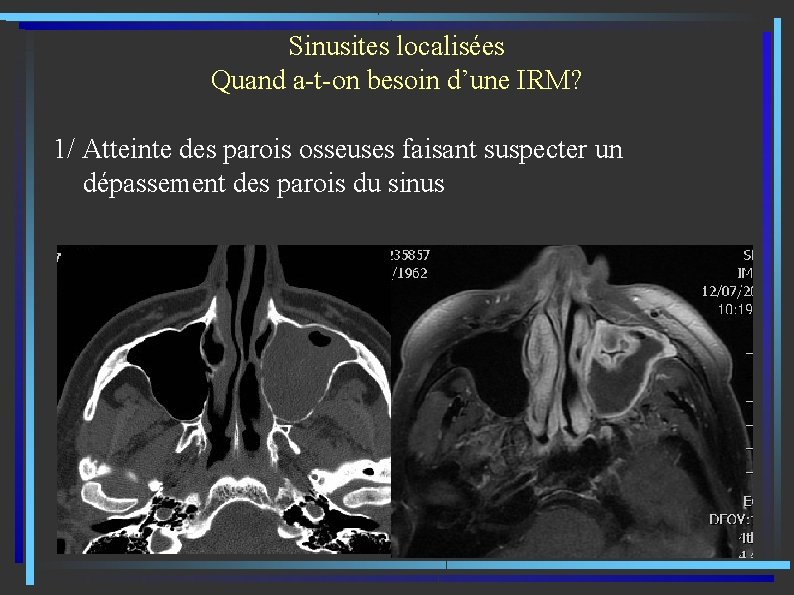 Sinusites localisées Quand a-t-on besoin d’une IRM? 1/ Atteinte des parois osseuses faisant suspecter