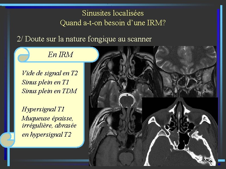 Sinusites localisées Quand a-t-on besoin d’une IRM? 2/ Doute sur la nature fongique au