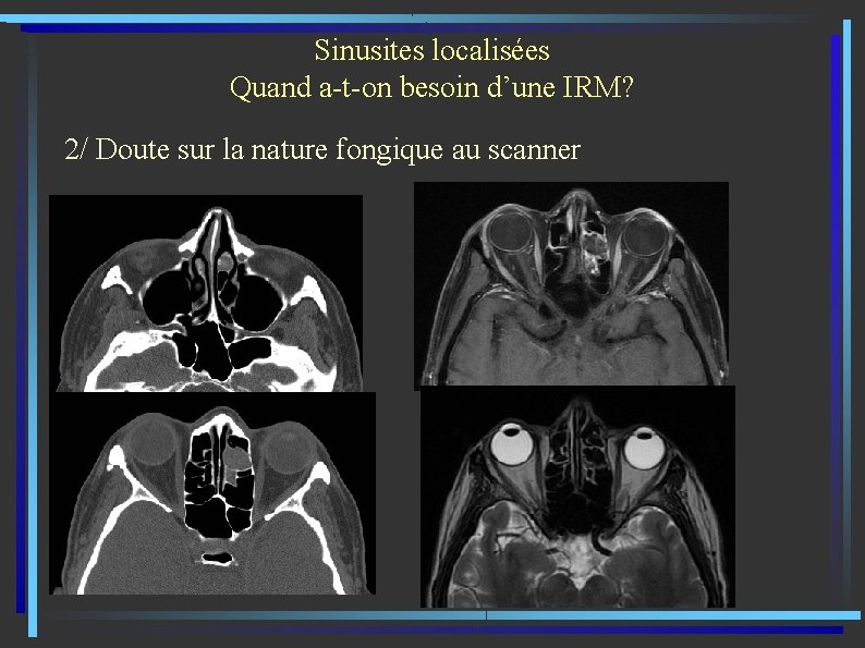 Sinusites localisées Quand a-t-on besoin d’une IRM? 2/ Doute sur la nature fongique au