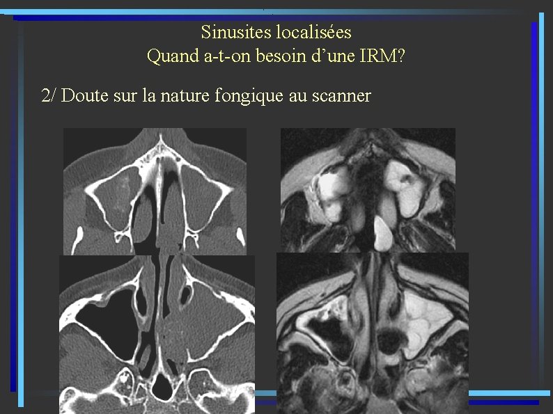 Sinusites localisées Quand a-t-on besoin d’une IRM? 2/ Doute sur la nature fongique au