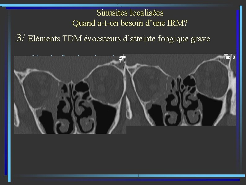 Sinusites localisées Quand a-t-on besoin d’une IRM? 3/ Eléments TDM évocateurs d’atteinte fongique grave