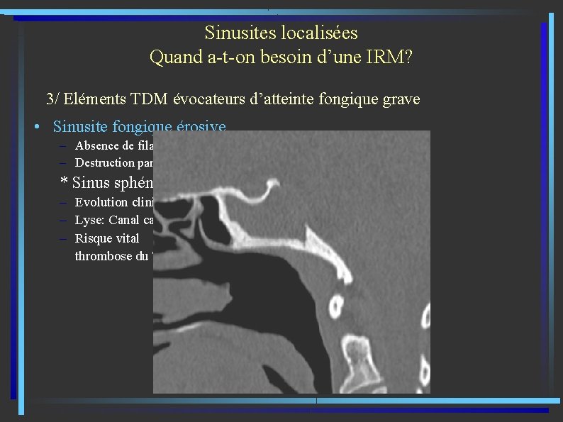 Sinusites localisées Quand a-t-on besoin d’une IRM? 3/ Eléments TDM évocateurs d’atteinte fongique grave